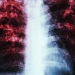 South Africa: As With Covid-19, the Effects of TB Can Linger Long After It Is Cured