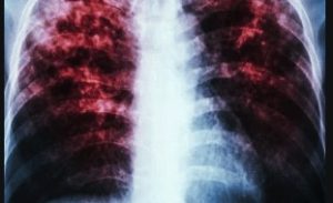 South Africa: As With Covid-19, the Effects of TB Can Linger Long After It Is Cured