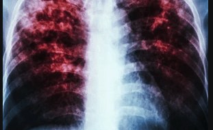 South Africa: As With Covid-19, the Effects of TB Can Linger Long After It Is Cured