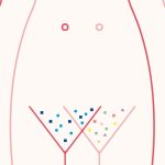 Why the vaginal microbiome may be key to treating bacterial vaginosis