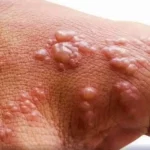 WHO says mpox still int’l public health emergency