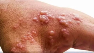 WHO says mpox still int’l public health emergency