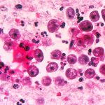 Man in Florida killed by rare, brain-eating amoeba Naegleria fowleri