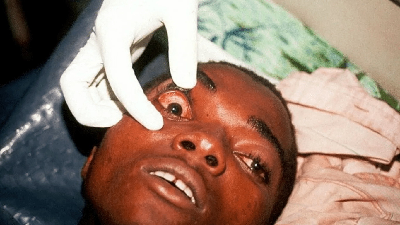 Tanzania confirms outbreak of deadly Marburg virus