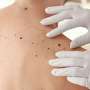 Risk for skin cancer higher for adults with atopic dermatitis