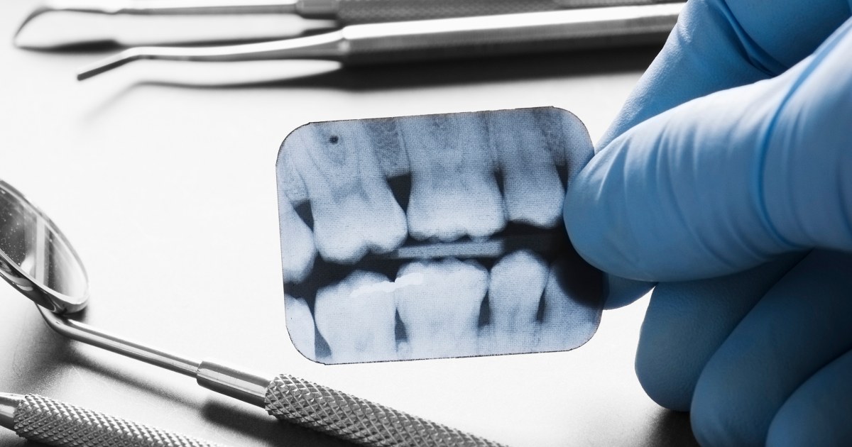 Millions expected to lose dental care coverage after Medicaid review