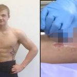 College wrestler nearly lost his leg after bruise turned out to be a flesh-eating infection