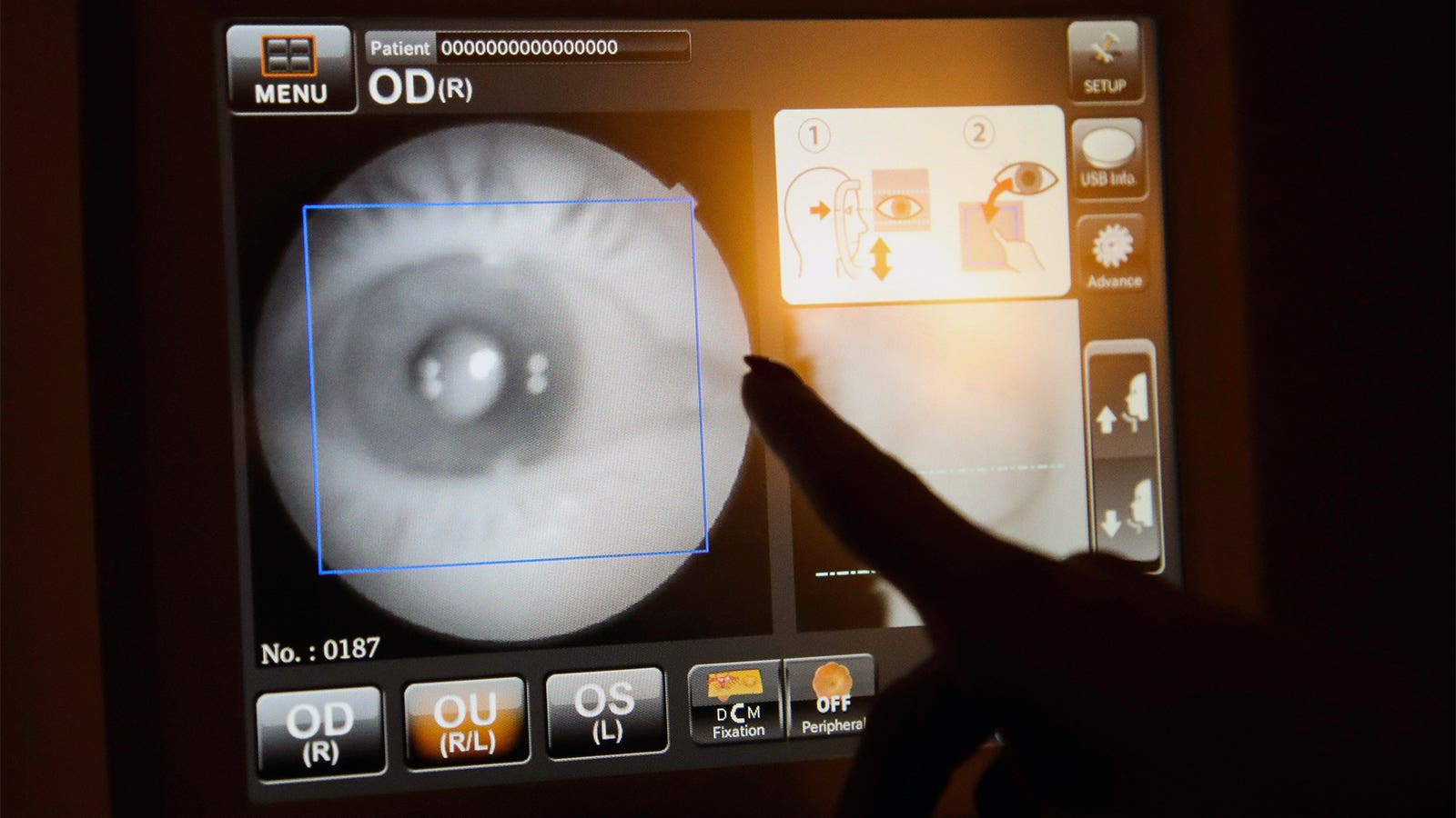 Diabetes-Related Eye Disease Remains High in the U.S.