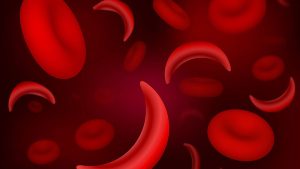 Soroh advocates more awareness on sickle cell