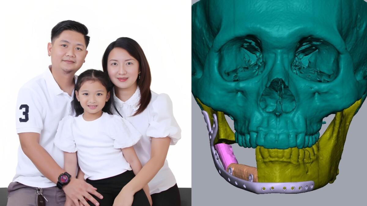 ‘Will my 6-year-old daughter recognise me?’ Dubai Filipino expat with facial tumour undergoes 3D-printed surgery