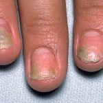 EULAR Offers Tips on Psoriasis Progression to PsA