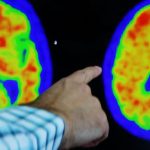 Acumen’s Alzheimer’s drug passes initial safety test