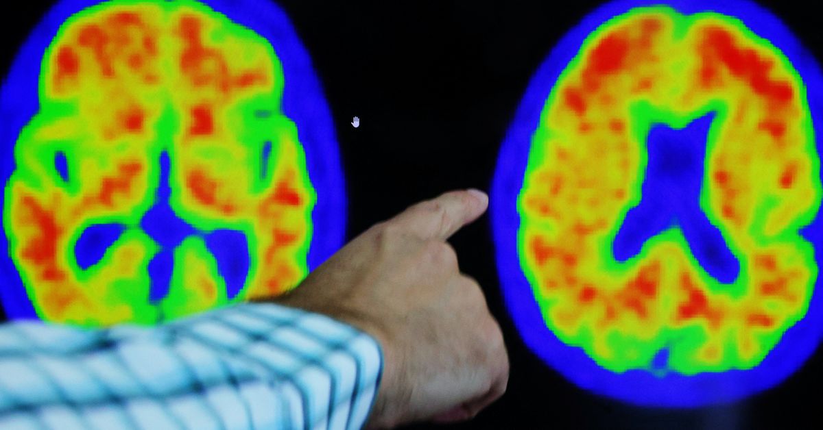 Acumen’s Alzheimer’s drug passes initial safety test