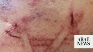 Israeli forces allegedly brand Star of David on Palestinian man’s cheek