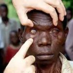 FG to launch national strategic eye health plan to stem preventable blindness