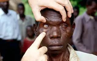 FG to launch national strategic eye health plan to stem preventable blindness