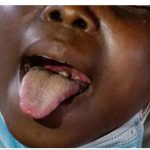 Diphtheria kills 10 in Jigawa