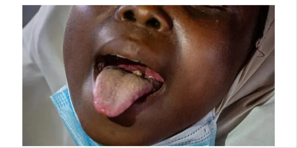 Diphtheria kills 10 in Jigawa