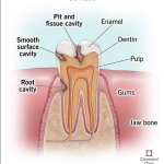 How do you get rid of dental cavities? Is cavity a serious problem?