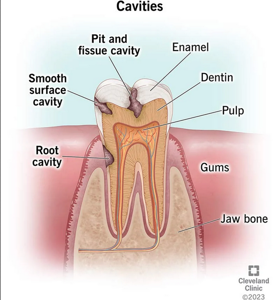 How do you get rid of dental cavities? Is cavity a serious problem?