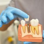 The Dental Implant Procedure: Preparation Stage