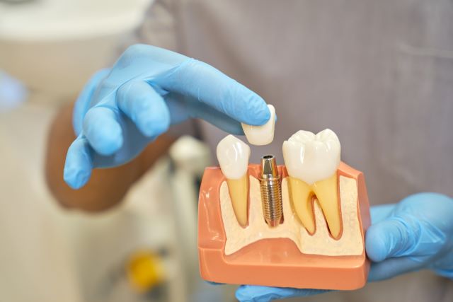 The Dental Implant Procedure: Preparation Stage