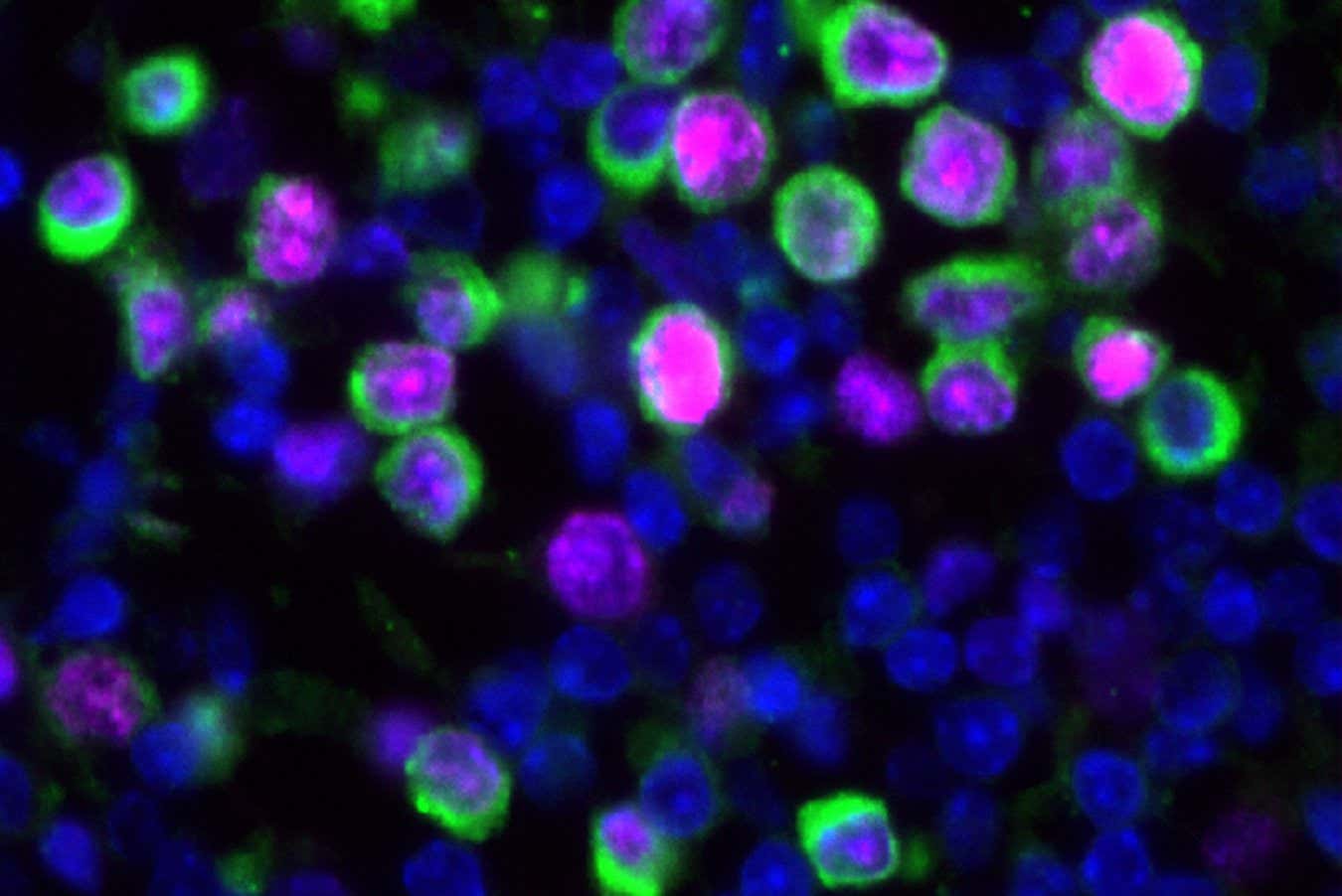 Covid-19 and flu may reawaken dormant cancer cells in the lungs