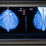 Hiding in Not-So-Plain Sight: AI Spots Interval Breast Cancers Missed on Mammography