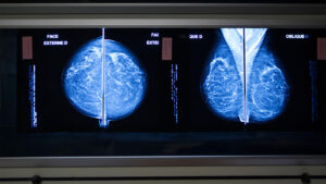 Hiding in Not-So-Plain Sight: AI Spots Interval Breast Cancers Missed on Mammography