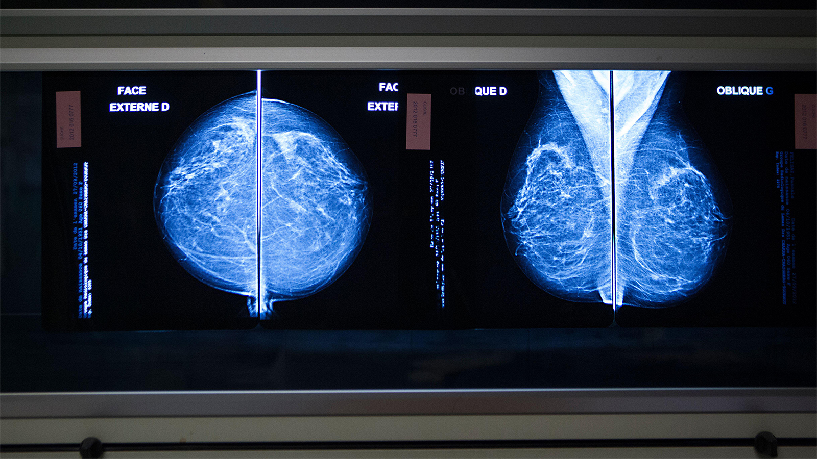 Hiding in Not-So-Plain Sight: AI Spots Interval Breast Cancers Missed on Mammography