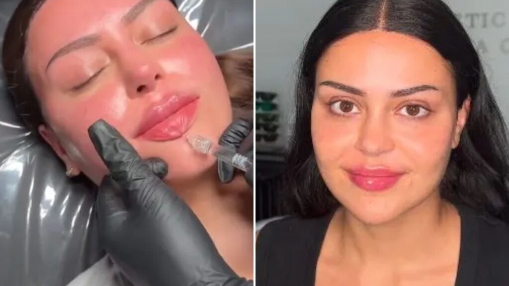 Love Island star Emma Munro’s pre-villa glow up as she gets lip, chin, and cheek fillers before reuniting with ex Harry