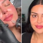Love Island star Emma Munro’s pre-villa glow up as she gets lip, chin, and cheek fillers before reuniting with ex Harry