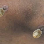 Can Lyme Disease Go Away on Its Own? 
