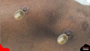 Can Lyme Disease Go Away on Its Own? 