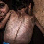 Famine’s toll on the children of Gaza: The world shouldn’t look away