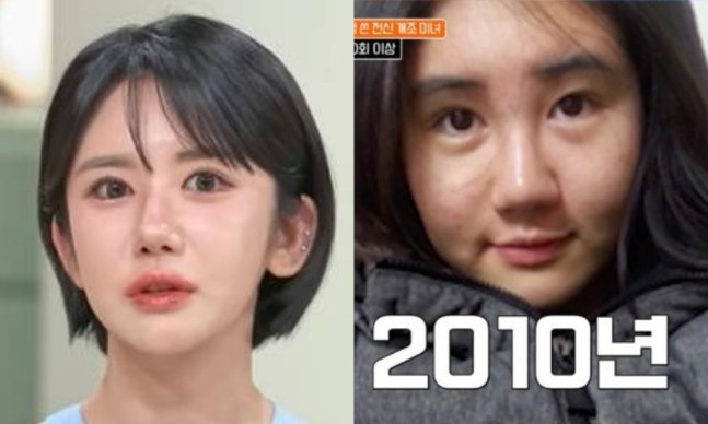 Woman Spends Over $200,000 on 400 Plastic Surgery Procedures Over 15 Years