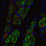 Nasal Drops Fight Brain Tumors Noninvasively | Mirage News