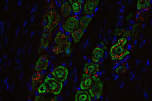 Nasal Drops Fight Brain Tumors Noninvasively | Mirage News