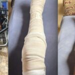 Baddy of Lagos finally removes leg cast, shares post-surgery recovery progress