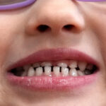 FDA Restricts Use of Kids’ Fluoride Supplements, Citing Emerging Health Risks