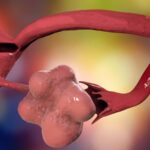 We’re closing in on how genetics may influence your PCOS risk