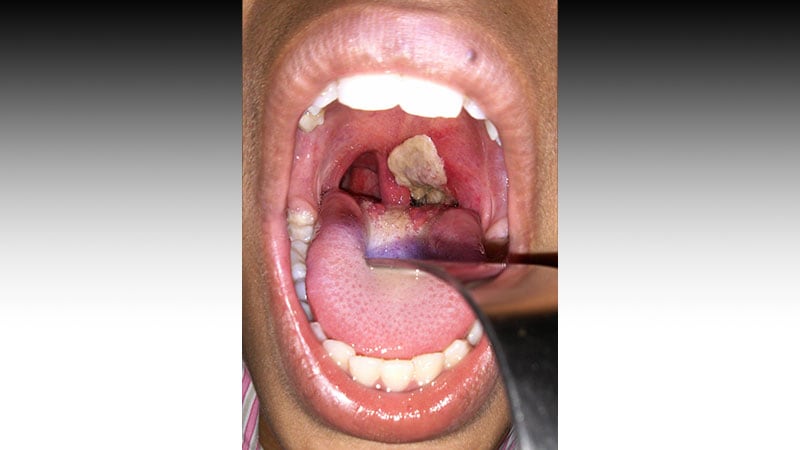 Missed Diagnoses Fuel Diphtheria’s Return in Europe