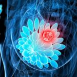 Europe Moves Forward With ESR1-Driven Breast Cancer