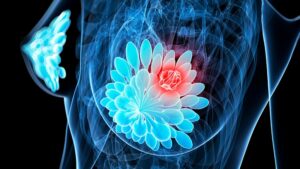 Europe Moves Forward With ESR1-Driven Breast Cancer