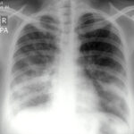 Combination Model May Improve Diagnosis of Serious Respiratory Infections