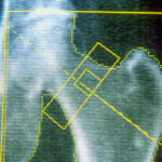 GLP-1s may increase risk of osteoporosis and gout, new research finds