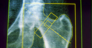 GLP-1s may increase risk of osteoporosis and gout, new research finds