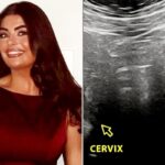 Woman Had Intense Periods. After Surgery at Age 19, She Discovered She Has an Extremely Rare Condition — 2 Wombs (Exclusive)