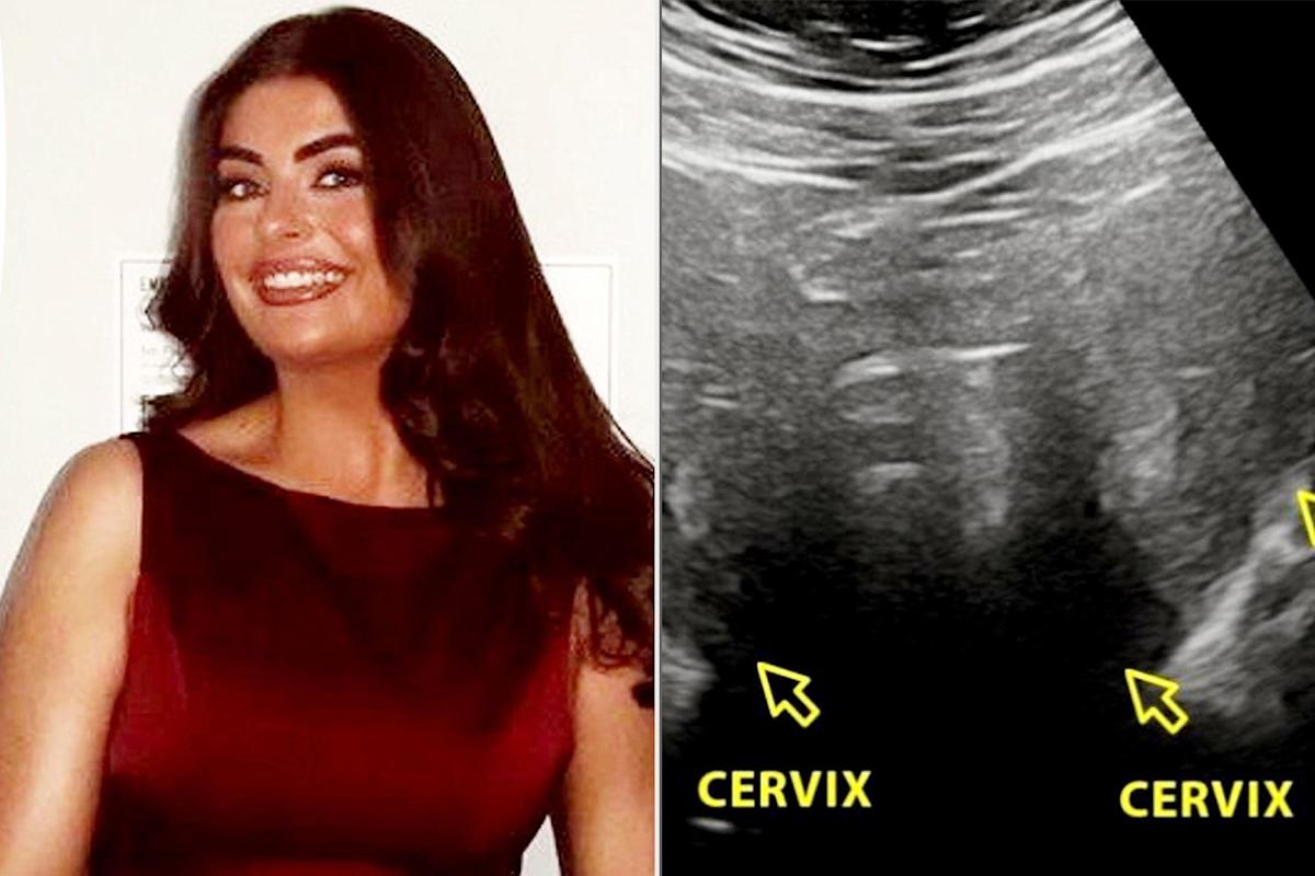 Woman Had Intense Periods. After Surgery at Age 19, She Discovered She Has an Extremely Rare Condition — 2 Wombs (Exclusive)