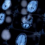 Psiquiatras podrían adoptar biomarcadores en el diagnóstico de la salud mental